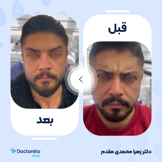 تزریق بوتاکس صورت (پیشانی، خط اخم، پنجه کلاغی)💉