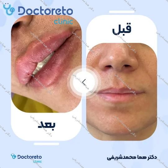 تزریق ژل لب