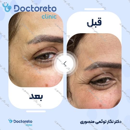 تزریق بوتاکس صورت (پیشانی، خط اخم، پنجه کلاغی)💉