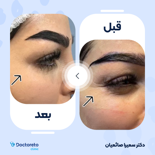 تزریق بوتاکس صورت (پیشانی، خط اخم، پنجه کلاغی)💉