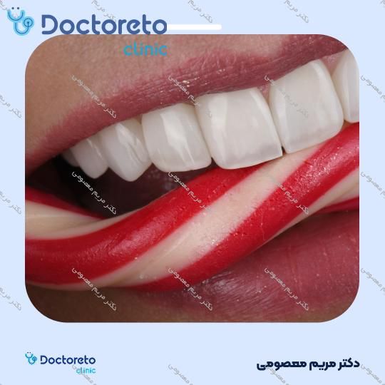 لمینت دندان (هر واحد)