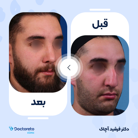 عمل زیبایی بینی استخوانی (رینوپلاستی)