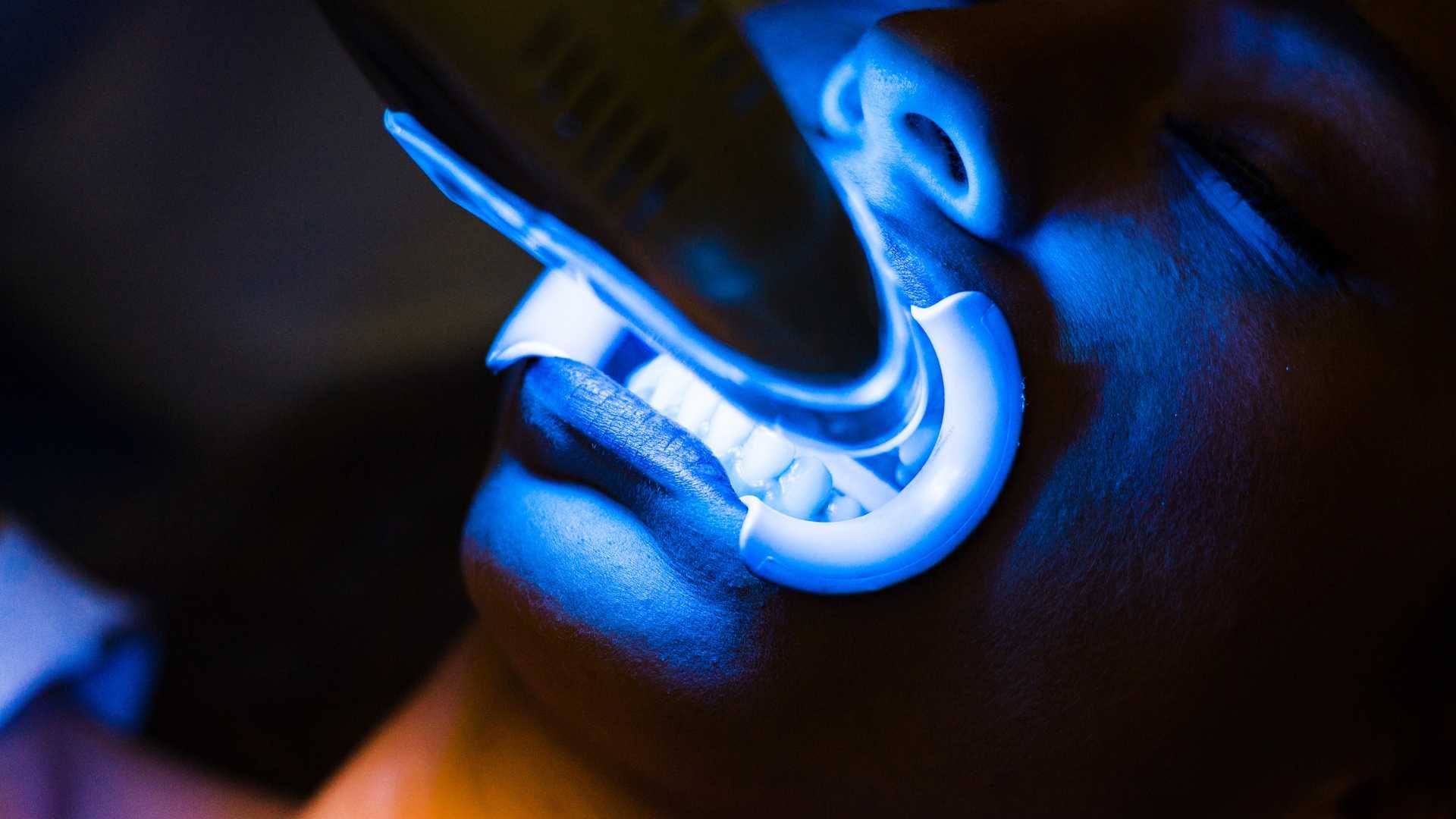 بلیچینگ دندان (سفید کردن دندان)