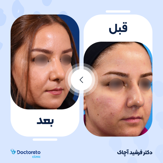 عمل زیبایی بینی گوشتی (رینوپلاستی)