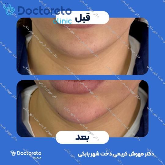 تزریق ژل لب