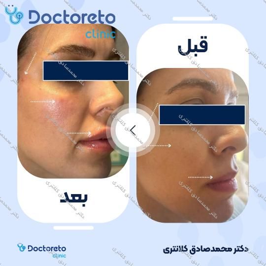 تزریق ژل لب