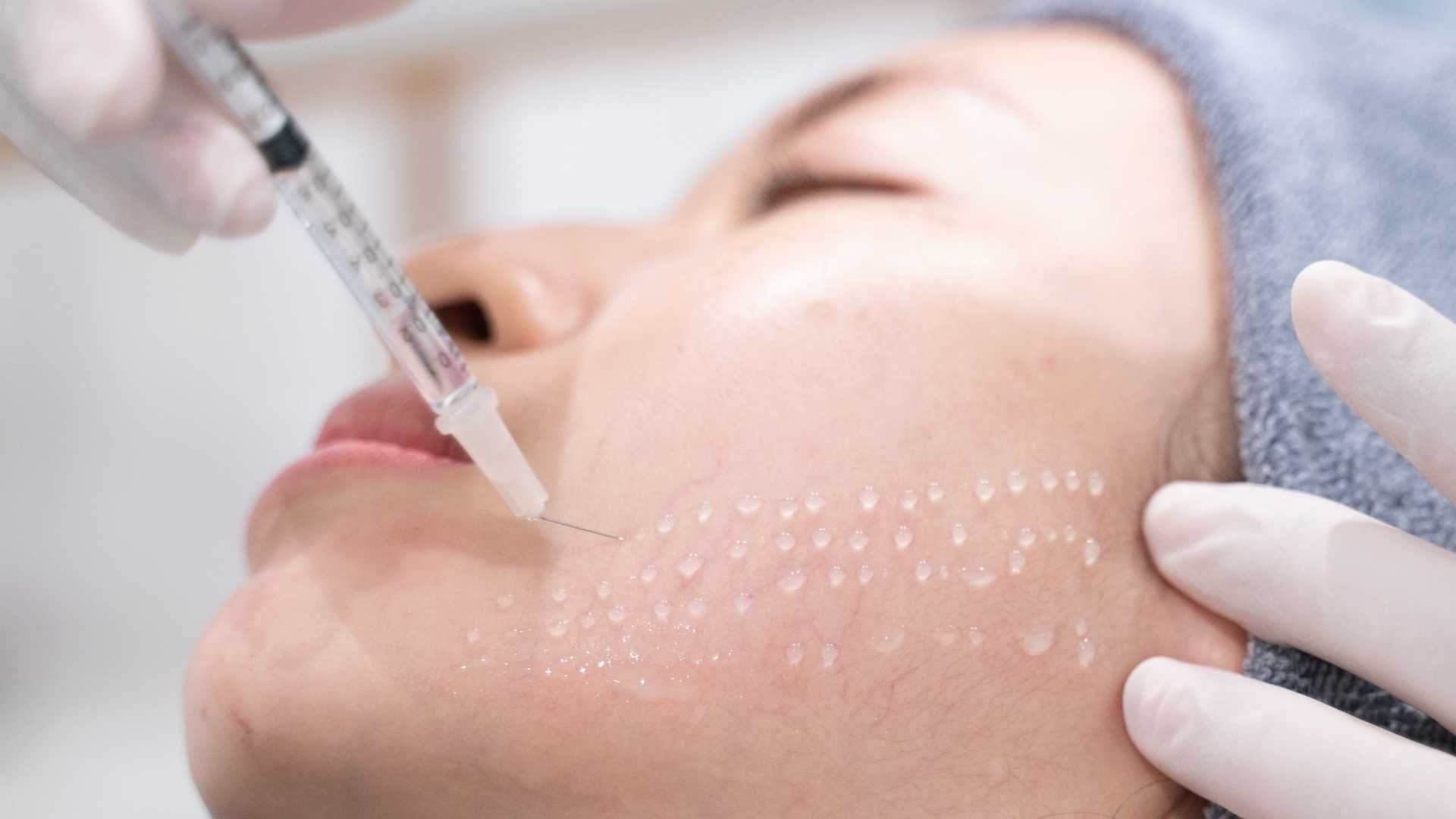 تزریق مزوتراپی برای جوانسازی صورت