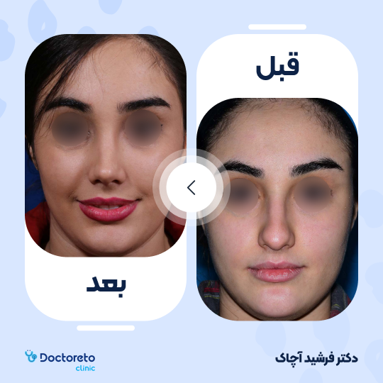 عمل جراحی زیبایی بینی (رینوپلاستی)