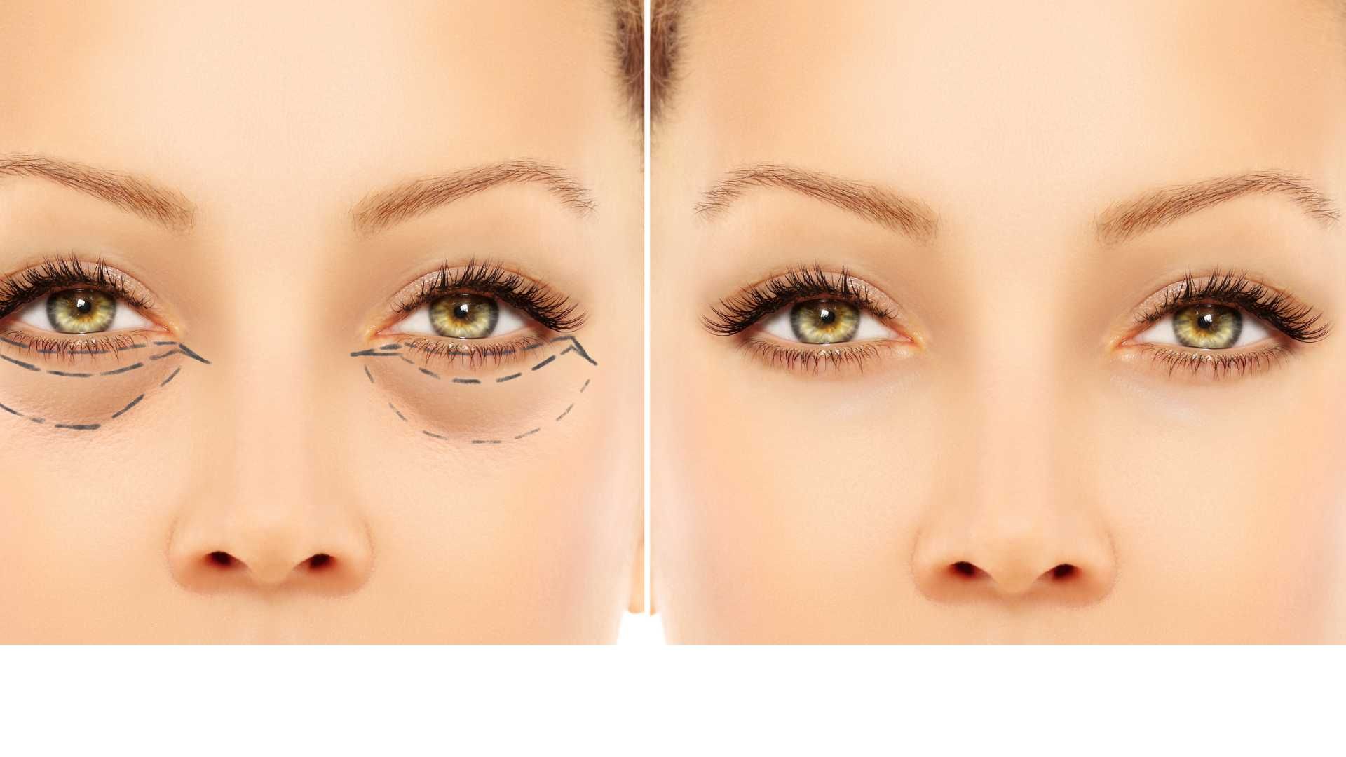 بلفاروپلاستی پلک‌های پایین به روش جراحی