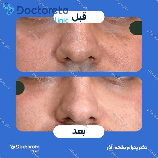 تزریق ژل زیرچشم