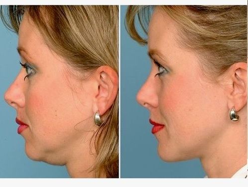 کاهش حجم چربی غبغب با تزریق مزوتراپی چربی سوز (هر جلسه)