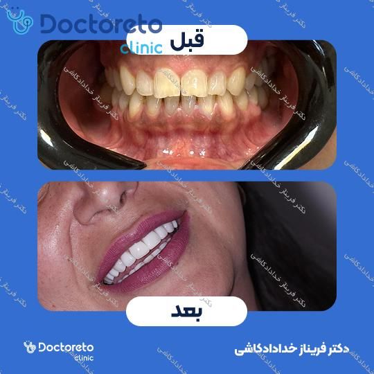 ونیر کامپوریت (هر واحد)