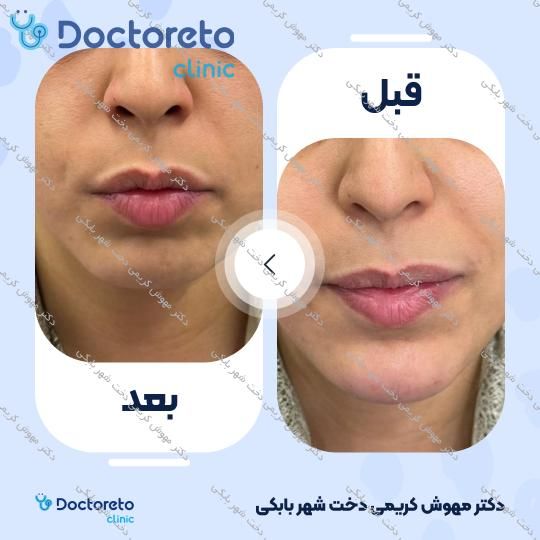 تزریق ژل چانه