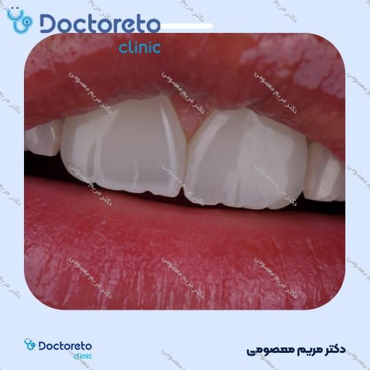 ونیر کامپوزیت (هر واحد)