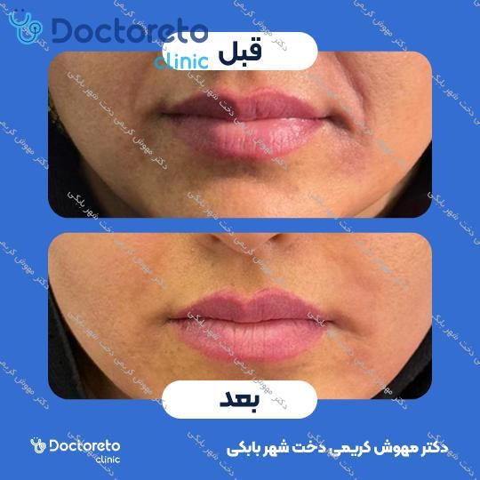 تزریق ژل خط خنده