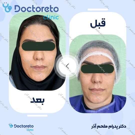 تزریق چربی به کل صورت