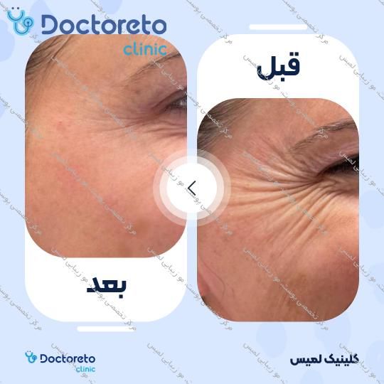 تزریق بوتاکس صورت (پیشانی، خط اخم، پنجه کلاغی)💉