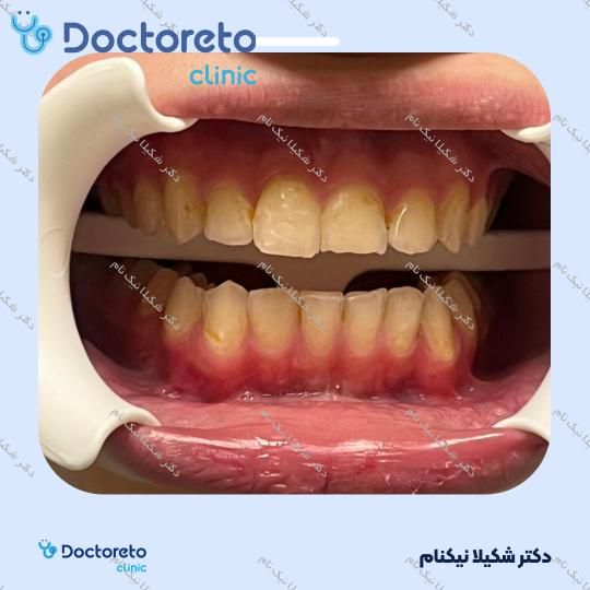 بلیچینگ دندان (سفید کردن دندان)