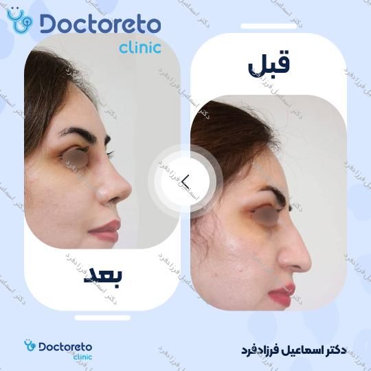 عمل زیبایی بینی (رینوپلاستی)