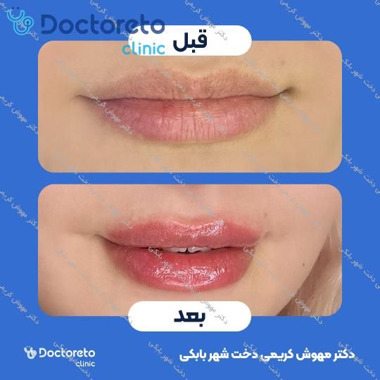 تزریق ژل لب