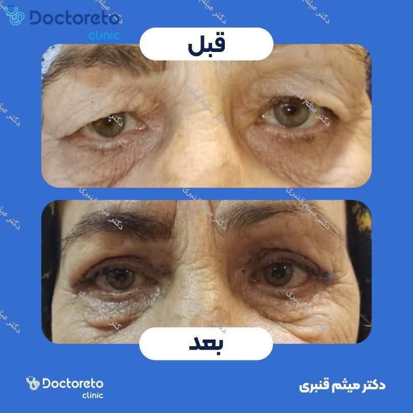 بلفاروپلاستی به روش جراحی