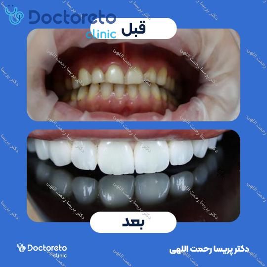 لمینت دندان (هر واحد)