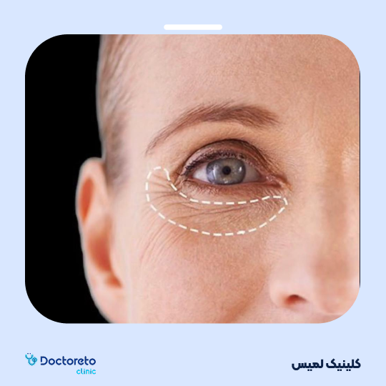 تزریق ژل زیرچشم