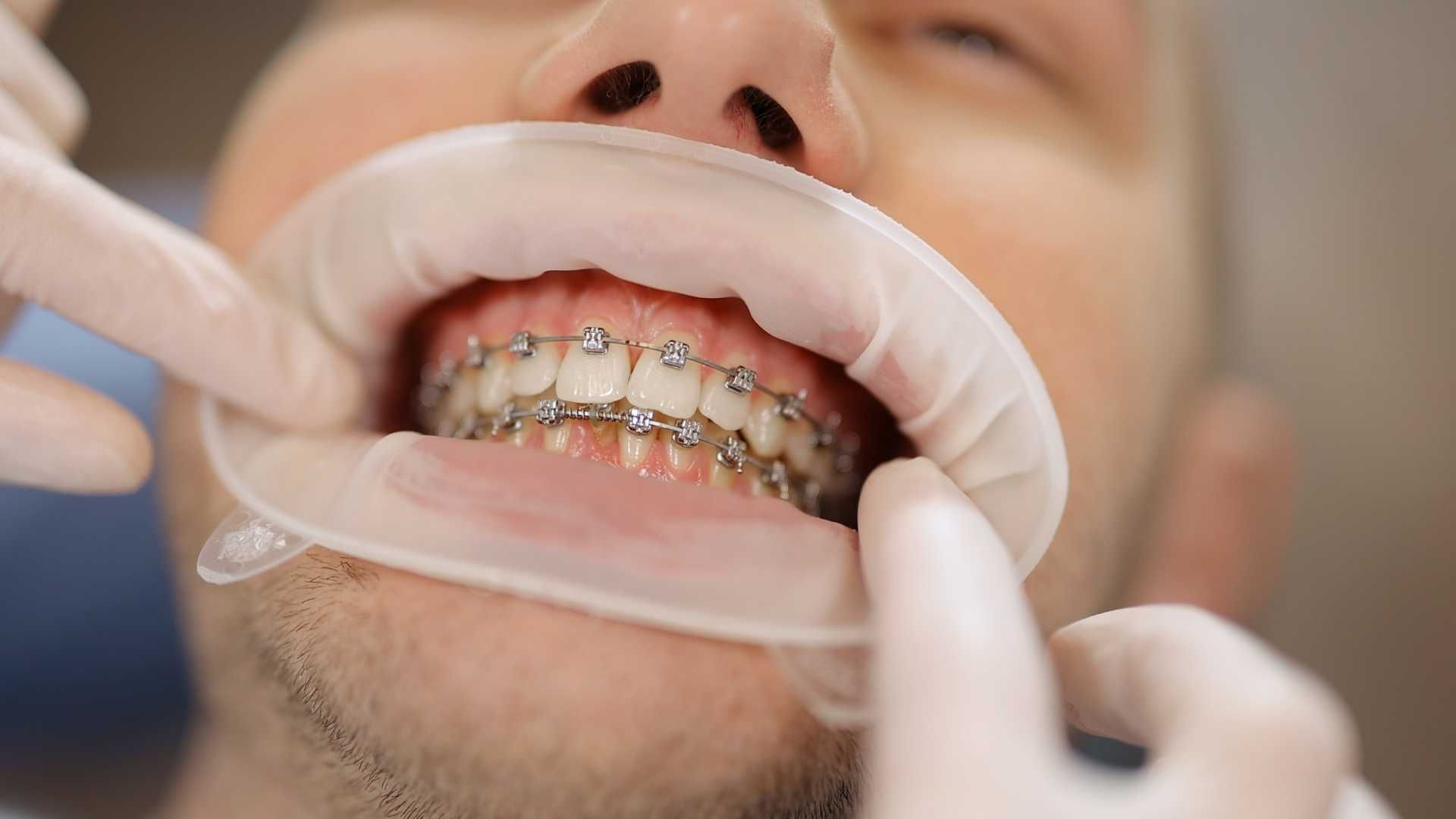 ارتودنسی ثابت سرامیکی