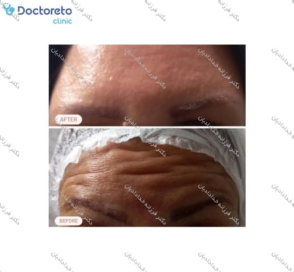تزریق بوتاکس صورت (پیشانی، خط اخم، پنجه کلاغی)💉