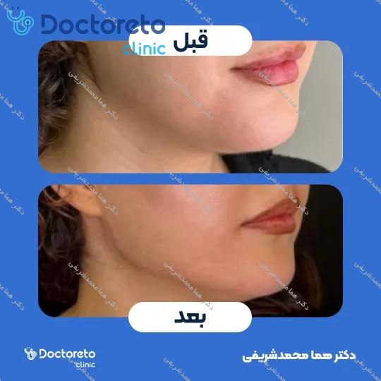 تزریق ژل لب