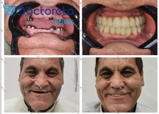 ایمپلنت دندان با روکش (هر واحد)