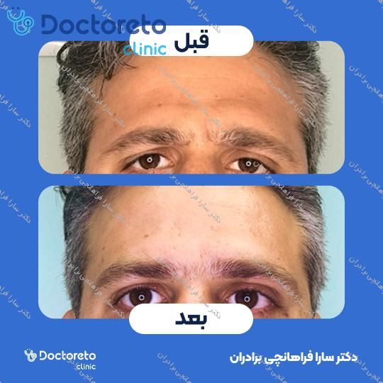 تزریق بوتاکس صورت (پیشانی، خط اخم، پنجه کلاغی)💉