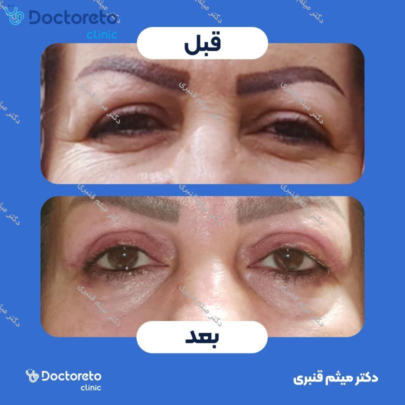 بلفاروپلاستی به روش جراحی