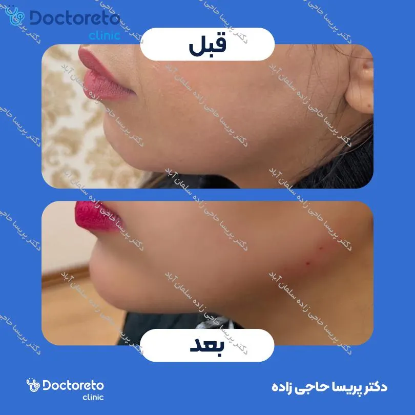 تزریق ژل چانه