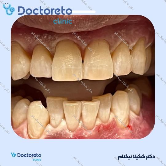 بلیچینگ دندان (سفید کردن دندان)