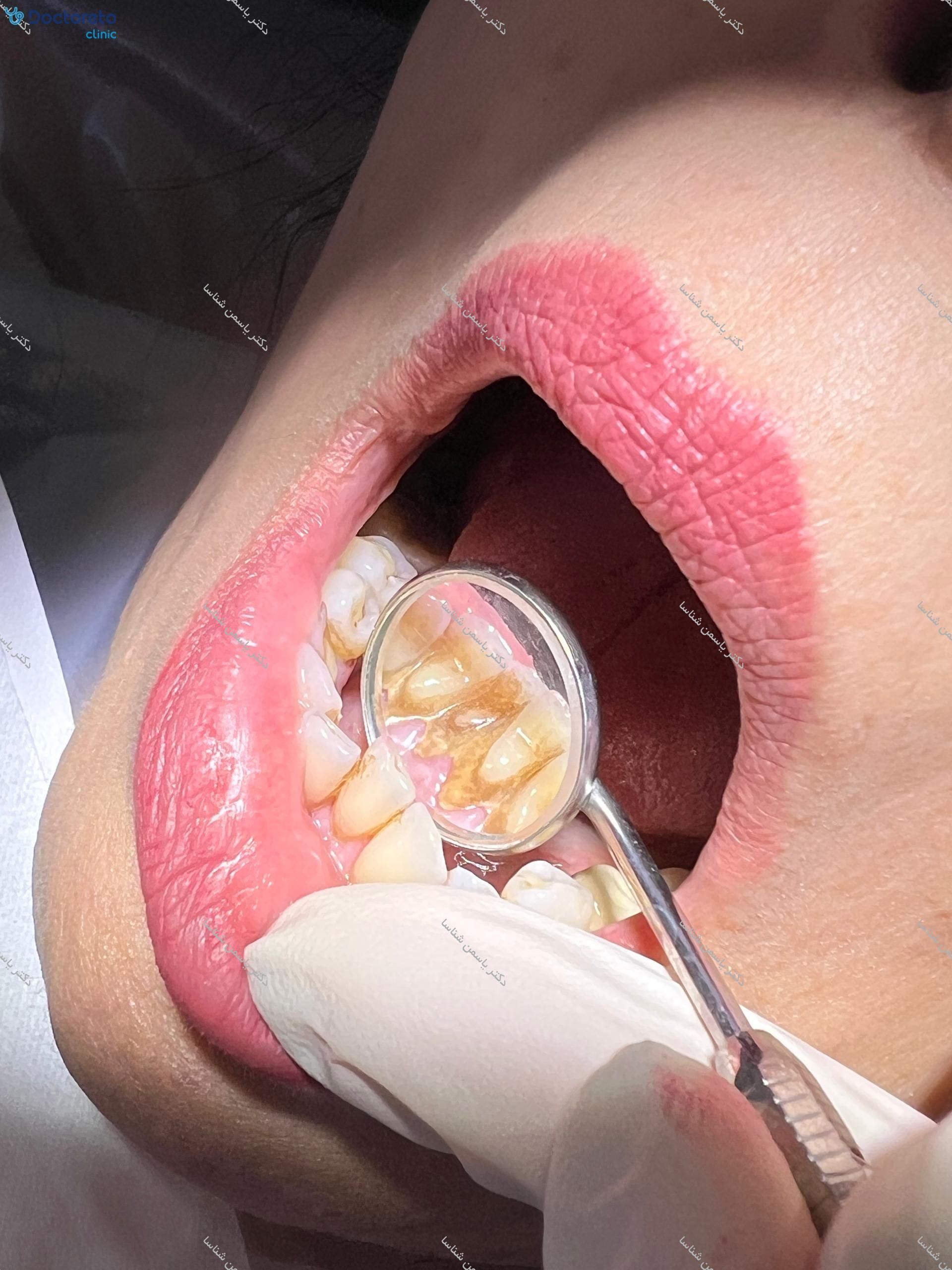 جرم گیری کامل دندان‌های دو فک با بروساژ🦷