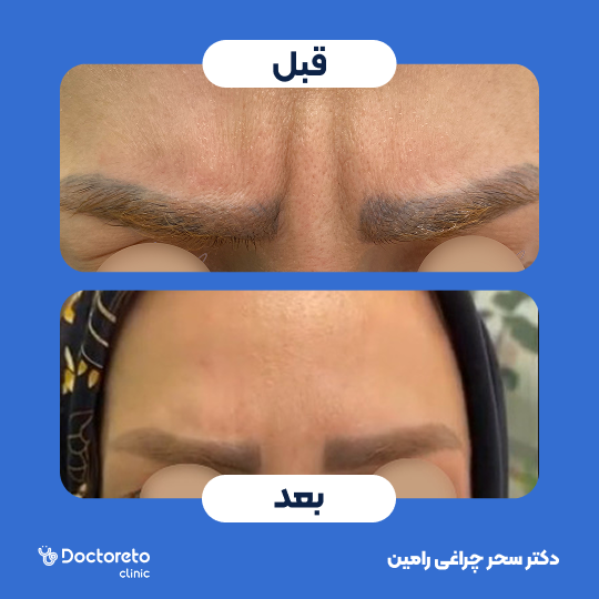 تزریق بوتاکس صورت (پیشانی، خط اخم، پنجه کلاغی)