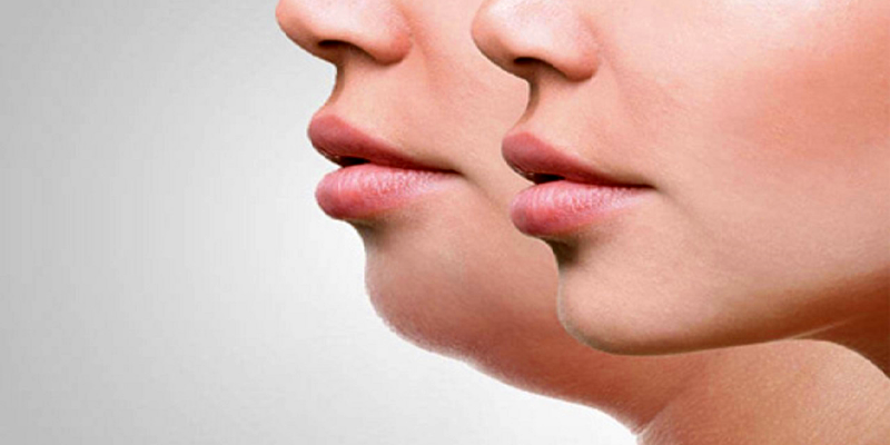 پکیج رفع غبغب با روش کربوکسی تراپی و RF (هر جلسه)