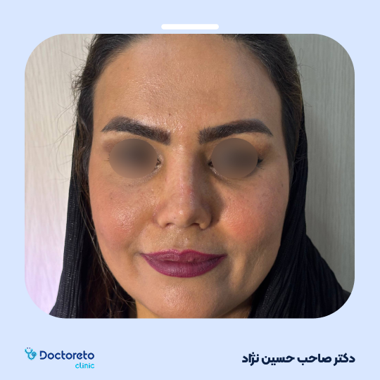 عمل زیبایی بینی گوشتی (رینوپلاستی)