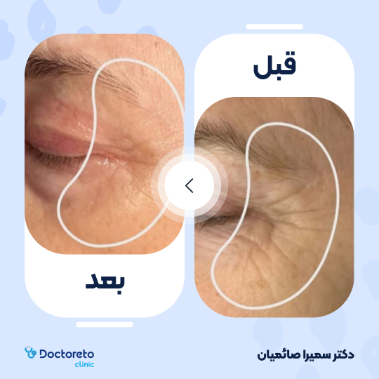 تزریق بوتاکس صورت (پیشانی، خط اخم، پنجه کلاغی)💉