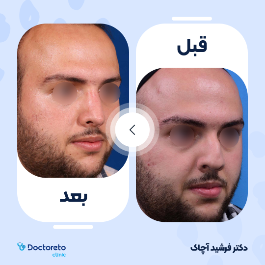 عمل جراحی زیبایی بینی (رینوپلاستی)