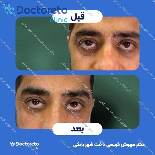تزریق ژل زیر چشم
