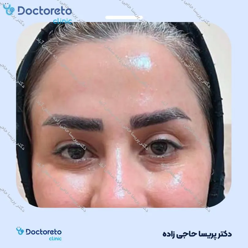 تزریق بوتاکس صورت (پیشانی، خط اخم، پنجه کلاغی)