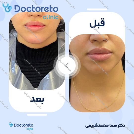 تزریق ژل چانه