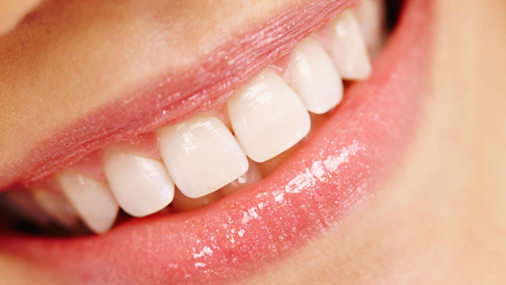 لمینت دندان (هرواحد)