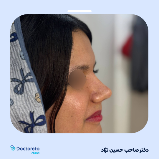 عمل زیبایی بینی استخوانی (رینوپلاستی)