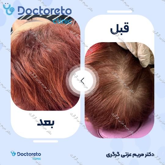 تزریق مزوتراپی جهت قطع ریزش مو