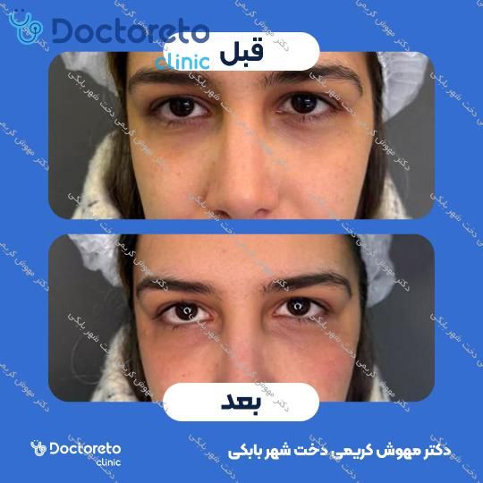 تزریق ژل زیر چشم