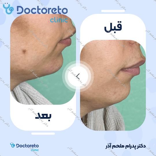 تزریق ژل چانه