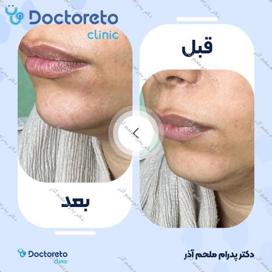 تزریق ژل چانه